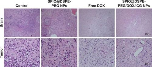 Figure 8 Histological sections of brain and tumor stained with H&E.Abbreviations: DOX, doxorubicin; DSPE-PEG, 1,2-distearoyl-sn-glycero-3-phosphoethanolamine-N-[methoxy(polyethylene glycol)]; ICG, indocyanine green; SPIO NPs, superparamagnetic iron oxide nanoparticles.