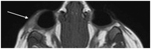 FIGURE 1. MRI showing 2.8-cm lobular mass in the superolateral right pre-septal orbit extending post-septally in the extraconal orbit above the lacrimal gland towards the posterior orbit with mild intrinsic T1 shortening, fat suppression, diffusion restriction most consistent with a lobular dermoid cyst.