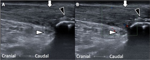 Figure 4 (A) Achilles tendon swelling and retrocalcaneal bursitis. Healing pattern was noted at tear site. (B) Inflammation was much relieved as revealed under color Doppler view. Black arrowhead, calcified lesions; white arrowhead: retrocalcaneal bursa; white arrow, Achilles tendon.