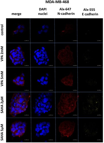 Figure 7 Confocal imaging of E-cadherin and N-cadherin expression in MDA-MB-468 cells cultured alone (control) or in the presence of VPA (2 mM, 5 mM) and SAHA (2 µM, 5 µM).Notes: Fixed cells were blocked and incubated with an anti-E-cadherin and anti-N-cadherin antibodies, followed by the respective secondary antibodies conjugated with Alexa fluorochromes as described in “Material and methods“ section. Nuclei were stained with DAPI. 100 x oil immersion objective was used. Representative images are shown.Abbreviations: SAHA, vorinostat; VPA, valproic acid.