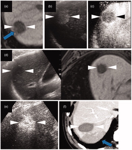 Figure 2. The local tumor progression (LTP) of a HCC lesion after radiofrequency ablation (RFA). (a) A hepatobiliary phase image of EOB-MRI shows the peritumoral hypointensity appearance (arrow). (b, c) Contrast enhanced ultrasound examination using a Sonazoid agent. The arterial phase image (b) exhibits a washed in appearance, while the post-vascular phase image (c) shows a washed out appearance. (d) Pre-operative fusion imaging combining a grayscale ultrasound (left side) and the hepatobiliary phase image of EOB-MRI as a reference (right side) on a single screen. Arrowheads in (a–d) indicate the margin of the lesion. (e) The grayscale ultrasound image shows the ablated area (arrowheads). (f) Portal phase of the contrast-enhanced CT image obtained four months after RFA shows the ablate area (arrowheads) and adjacent low density area (arrow), which suggests LTP. This lesion is from a 78 year-old male patient and was pathologically confirmed as poorly differentiated HCC (maximum diameter 23 mm) in segment VII.