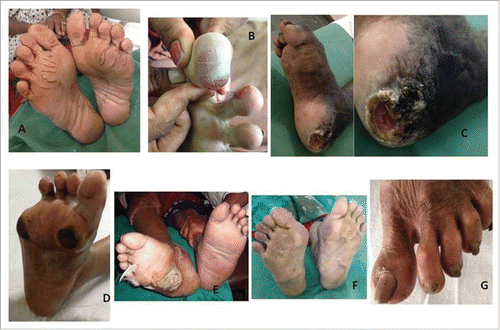 Figure 3. A: Plantar fissures B: Diabetic Blister C: Ulcer D: Ulcer with Squamous Cell Carcinoma E: Charcot Foot F: Hallux Valgus G: Claw toes.
