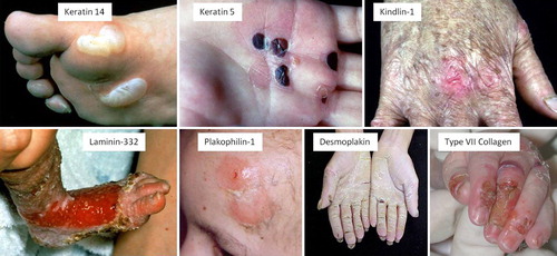 Figure 4. Clinical illustrations of different genetic disorders showing varying degrees of skin fragility. In each case the mutated skin protein is shown.