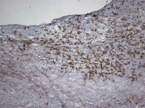 Figure 1. Immunoperoxidase‐staining for the leukotriene‐synthesizing enzyme 5‐lipoxygenase (brown) in atherosclerotic lesion from human carotid endarterectomy.