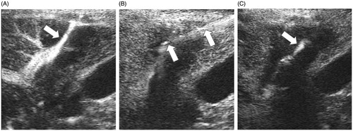 Figure 1. CEUS-guided ablation at needle tract. (A) CEUS showed continuous linear microbubble extravasated along the needle tract (white arrow). (B) Electrode was inserted into outer parts of needle tract which was near the capsule under the guidance of CEUS (white arrow). (C) CEUS showed no microbubble extravasation along the needle tract after thermal ablation. The high echo showed by white arrow was caused by the carbonisation of electrode, not needle tract bleeding.