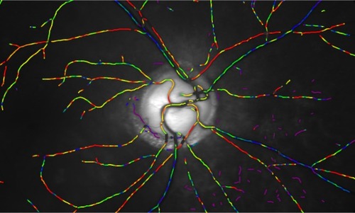 Figure 1 Image from the Oxymap system showing oxygen saturation in the retinal vessels.Citation30