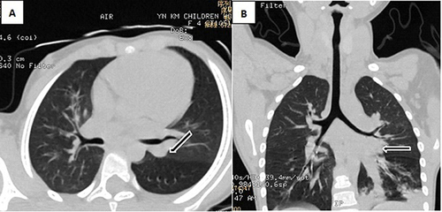 Figure 4 4-year-old boy presented with a recurrent cough for 2 weeks. Chest X-ray showed slightly increased translucency in the right lung, with no other abnormality seen. Further chest CT scan with airway reconstruction was performed, showing narrowing of the bronchial opening in the lower lobe of the left lung which was also seen to be filled with a high-density focus. Bronchoscopy was performed with purulent secretions seen and removed from the lower lobe of the left lung, resolving the cough.