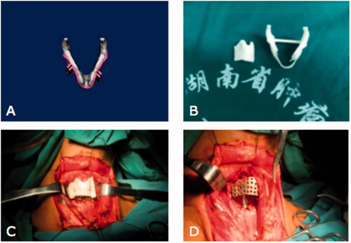 Figure 1. (A) The setting of the osteotomy line and the guide plate. (B) Simulation of the 3D-printed personalized titanium model. (C) Fixing of the guide plate with the osteotomy line. (D) Reconstruction of the thyroid cartilage with the 3D-printed personalized titanium model.