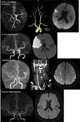 Figure 1 Representative cases of the four types of LAA mechanism (diffusion-weighted image and CTA images of the four types of LAA mechanism).