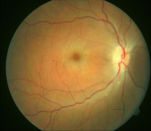 Figure 1 Right eye fundus photography taken at presentation of a forty-year-old male who gave a six-day history of sudden loss of vision in the eye. Prior to his presentation, CRAO had been diagnosed and ocular digital massage was performed without an improved vision. He had a visual acuity of counting fingers and features of central retinal artery occlusion with mild retinal edema and faint cherry-red spot. These findings are suggestive of incomplete CRAO. Surgical intervention on day 9 after symptom onset consisting of combination vitrectomy with manipulation of intraocular pressure resulted in a Snellen visual acuity of 6/60 which was maintained after 6 months of follow-up.