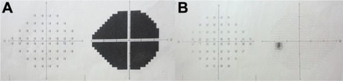 Figure 2 Humphrey 24-2 visual field of the right and the left eyes at the initial examination. (A) Right eye; (B) left eye.