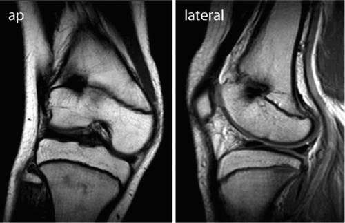 Figure 5. MRI showed a bony bridge anteriorly and laterally in the distal femoral physis.