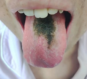 Figure 1 Black hairy tongue on the dorsum of the tongue.