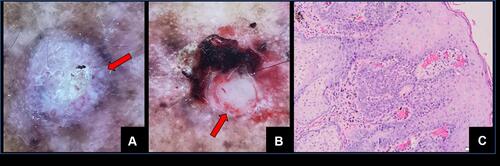 Figure 2 (A) Dermoscopy examination performed on nodules and ulcer showed a visible white circle (B) white structureless area (C), and histopathology examination revealed polymorphic and atypical cells with an increase of mitotic nuclei.