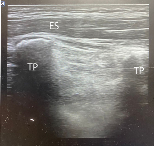 Figure 1. Ultrasound guided erector spinae plane block. ES: erector spinae muscle, TP: transverse process.
