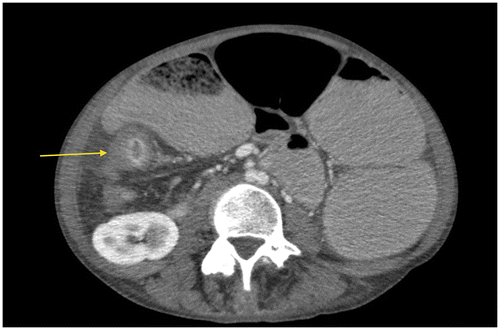 Figure 6b: Axial CT showing gross SBO with a target sign in the right iliac fossa secondary to active Crohn’s disease