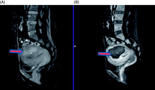 Figure 1. Contrast enhanced MR images obtained from a 45-year-old patient with adenomyosis. (A) Pre-procedure MRI shows a 4.9 × 4.8 × 3.3 cm adenomyotic lesion located at the posterior wall of the uterus (arrow). (B) Contrast-enhanced MRI obtained 1 day after HIFU shows the fractional ablation was 90.8% (arrow).