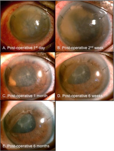 Figure 2 After removal of the total hyphema, the corneal bloodstaining cleared centrifugally from the peripheral to the central corneal stroma and from the posterior to the anterior corneal stroma.