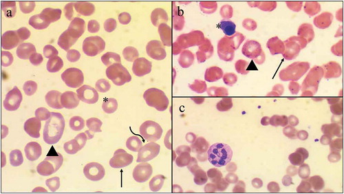Figure 1. Light Microscopy of a Peripheral Blood Smear in a patient with megaloblastic anemic secondary to severe vitamin B12 deficiency. Light Microscopy demonstrates the presence of numerous red blood cell morphologies including ovalocytes (arrow), target cells (arrowhead), teardrop cells (curved arrow), and schistocytes (asterisk); Panel A. Numerous Howell-Jolly bodies (arrows), basophilic stippling (arrowhead), and a nucleated red blood cell (asterisk) are also seen; Panel B. A solitary hyper-segmented neutrophil is appreciated on a background of macro-ovalocytes; Panel C
