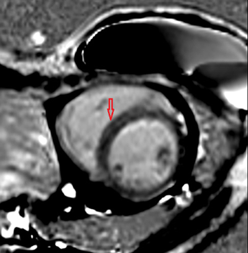 Figure 7 Streaky late gadolium mid-myocardial enhancement in the septal region (red arrow).