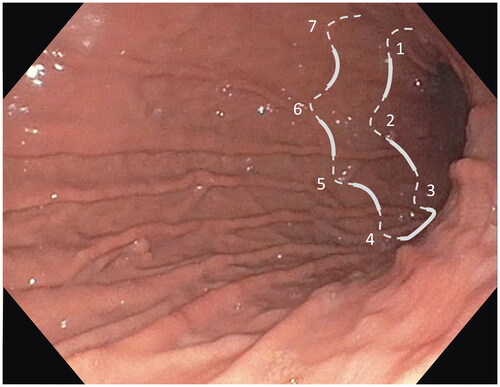 Figure 1. Endoscopic image of the stomach with an illustration of a U-pattern suture made by 6–8 full thickness stitches. The greater curve of the stomach was pleated by sequential U-pattern sutures starting at the level of the incisura and moving proximally.