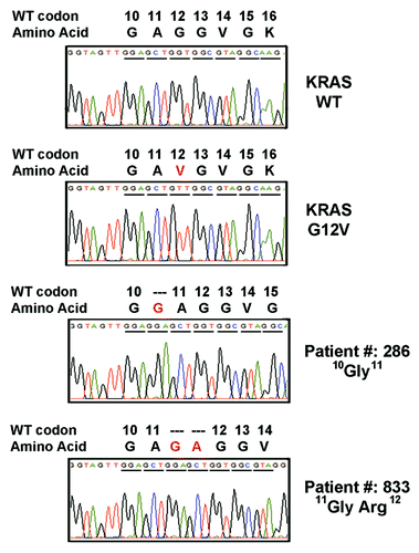 Figure 1. Electropherogram for KRAS mutants. Tissue DNA from the patient with colorectal cancer were amplified and cloned for sequencing analysis. Two novel in-flame insertions (10G11 and 11GA12) in exon 2 of KRAS gene were identified.