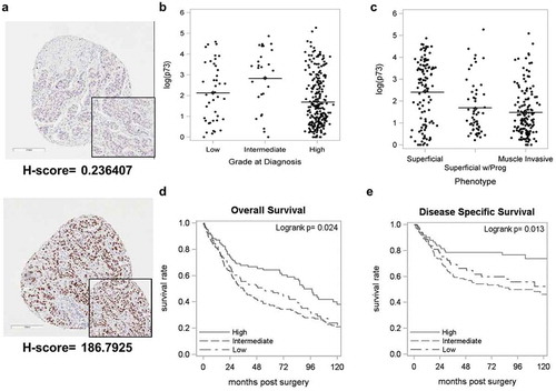 Figure 1. Loss of TAp73 expression in MIBC is associated with lower overall survival.Primary tumor samples from 338 bladder cancer patients were stained for TAp73 expression and analyzed using Aperio ScanScope. Protein expression was defined by H-scores, calculated as described in materials and methods. (a) Immunohistochemical staining showing representative images with positive and negative staining of TAp73. (b&c) Tap73 H-scores based on grade or phenotype. (d&e) Kaplan-Meier plot of overall and disease-specific survival in individuals stratified into quartiles (High > 16.1, 1.06 ≤ Intermediate ≤ 16.1, Low < 1.06) based on TAp73 H-scores. Clinicopathological characteristics of this patient cohort are detailed in Supplementary Table 1.