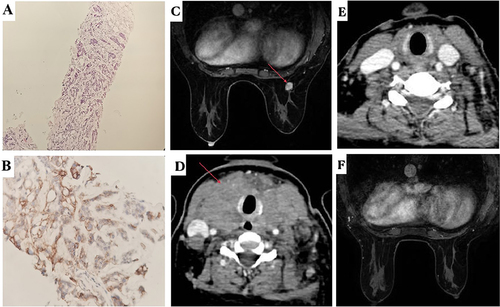 Figure 2 (A) HE staining of the right breast mass showed invasive carcinoma of the breast. (B) IHC examination revealed the right breast mass was positive for PD-L1. (C) Breast MR showed a significantly enlarged right breast mass (1.6cm x 1.2cm x 1.1cm) (red arrow) after 3 cycles of TE regimen chemotherapy. (D) CT scan of the neck, chest and abdomen showed significantly enlarged metastases (red arrow) in the thyroid gland after 3 cycles of TE regimen chemotherapy. (E) CT showed thyroid metastases regressed completely following 6 cycles of albumin paclitaxel plus PD-1 antibody. (F) MR showed right breast lesion regressed completely following 6 cycles of albumin paclitaxel plus PD-1 antibody.