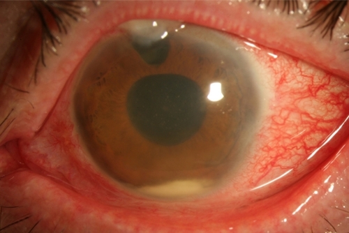 Figure 2 Photograph of left eye of 67-year-old male presenting with culture-negative BAE. Presenting VA: 20/200, IOP: 10 mmHg. Treatment: tap and injection. Final VA 20/200, IOP 16 mmHg. Culture-negative cases were associated with better VA outcomes than culture-positive cases.