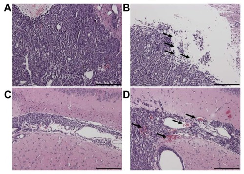 Figure 9 The structure of the contralateral brain tumor without sonication (A and C) and of the brain tumor tissue with sonication (B and D) by H&E staining (original magnification × 100 from Figure 7B; scale bar = 200 μm). Local displacement and increased extravasation of red blood cells were indicated by arrows in the sonicated tumor tissues in and around the focal region.Abbreviation: H&E, hematoxylin-eosin.