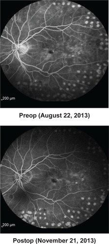 Figure 3 Fluorescence angiographic findings for patient number 5, left eye pre- and 2 months postinjection of 190 μg FAc. The intravitreal injection of FAc took place on September 26, 2013.