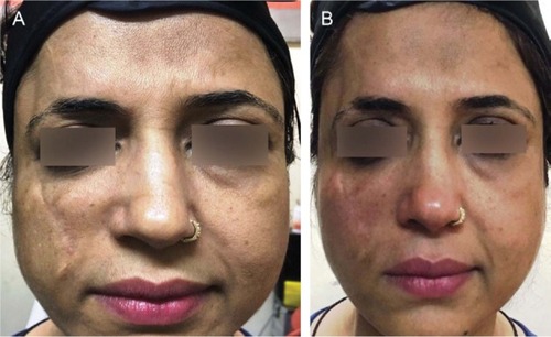 Figure 1 (A) Patient before scar correction with hyaluronic acid fillers. (B) Patient after 2 mL of hyaluronic acid filler.