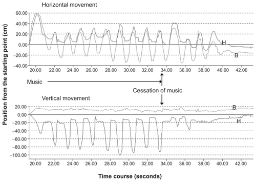 Figure 2 Changes in motion by the abrupt cessation of music in a 7-year-old patient.