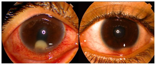 Figure 5 (Right) The similarity in location between the phlycten (superficial phlyctenular keratitis; arrow); and (Left) a pearl-like lesion in the anterior chamber (arrow), which may be a form of posterior phlyctenular keratitis.