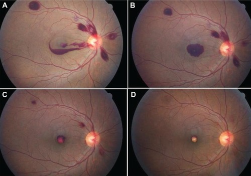 Figure 2 A: a 38-year-old patient with layered subhyaloid hemorrhage sparing the fovea in the right eye. B: 2 weeks later, the fovea is fully covered by preretinal hemorrhage. C: 1 month after last photograph, the preretinal hemorrhage has partially resorbed. D: 1 month thereafter, the residual organized blood clot has given a pseudo-hypopyon appearance.
