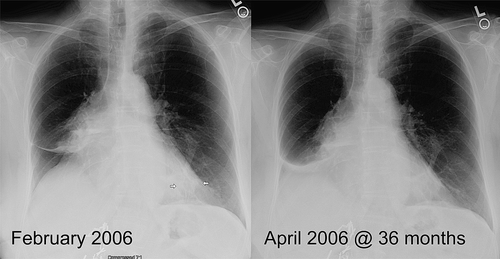 Figure 4.  Same patient as in Figure 3. A chest x-ray at 34 months documents patent airways; however, at 36 months occlusion of the right lower bronchus with subsequent atelectasis of the right lower lobe was observed.