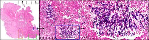 Figure 2 Histopathological examination of the vegetation by HE staining. The boxes with different colors represent the presence of Aspergillus lesions, and the black arrow is used to point to the enlarged image of Aspergillus lesion in the blue box.