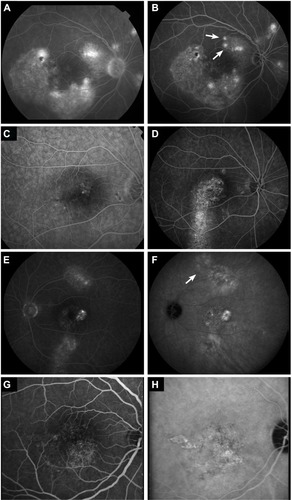 Figure 2 Abnormalities on fluorescein angiography (FA), indocyanine green angiography (ICGA), and fundus autofluorescence in chronic central serous chorioretinopathy.
