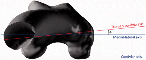 Figure 3. The angle between the medial-lateral and transepicondylar axes when viewed in the transverse plane.