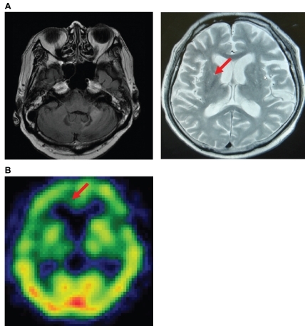 Figure 1 MRI (A) and SPECT (B) findings in day 0 after administration demonstrating old left cerebeller infarctions and lacunar infarctions exist in the bilateral basal ganglia in MRI and an area of hypoperfusion in bilateral frontal region was found in SPECT.