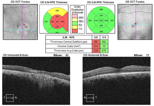Figure 5 The OCT finding of the second case. (Left) The result revealed macular thinning in the right eye and epiretinal membrane formation, with choroidal shadowing. (Right) The left eye image was unremarkable.