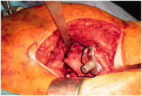 Figure 1. Anterior hip capsule during THA of the right hip (encircled with a black line).