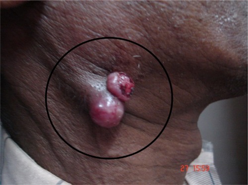 Figure 2 Ulcerated jugulodigastric node.