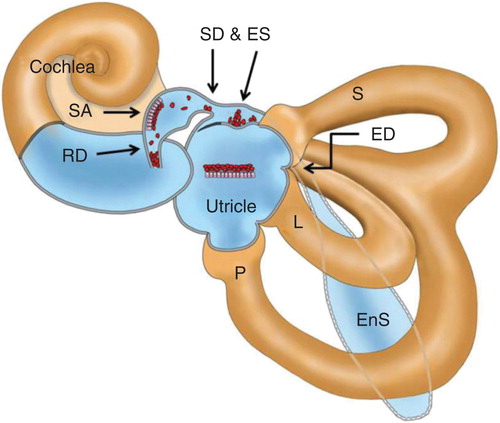 Figure 9. Hypothetical view of blockage of the reuniting duct (RD), saccular duct (SD) and endolymphatic sinus (ES) by dislodged otoconia from the saccule in patients with Meniere's disease (MD). ED, endolymphatic duct; EnS, endolymphatic sac; L, lateral semicircular canal; P, posterior semicircular canal; S, superior semicircular canal; SA, saccule.