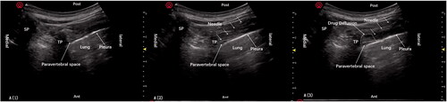 Figure 2. Paravertebral space puncture under ultrasound guidance.