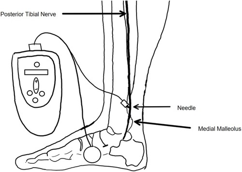 Figure 1 Percutaneous Tibial Nerve Stimulation (PTNS).