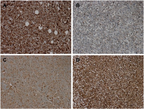 Figure 19 Immunohistochemical staining results of tumor apoptotic proteins (A is a control group BCL2, which is strongly positive; B was weakly positive in the treatment group BCL2; C was the control group caspase-3, which was moderately positive, and D was the treatment group caspase-3, which was strongly positive; ×200).