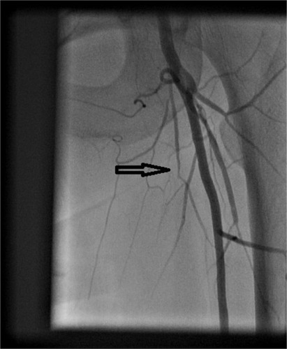 Figure 2 Angiogram showing occluded left superficial femoral artery (arrow).
