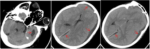 Figure 2 CT examination on the fifth day after admission.