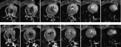 Figure 1. Gadophrin III-enhanced multislice short axis views of hypertrophied hearts subjected to 25 min ischemia and 3 h reperfusion. Top row: Hypertrophied hearts without treatment. Bottom row: Hypertrophied heart with infusion of Nicorandil after 15 min of occlusion for 3 hours. Note the difference in infarction size after nicorandil treatment of hypertrophied hearts.